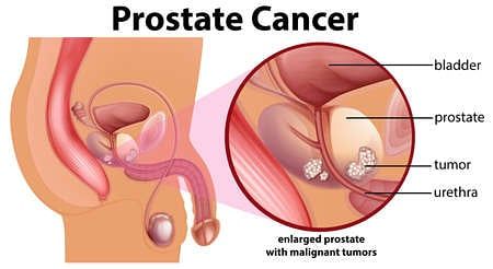 el cáncer urológico