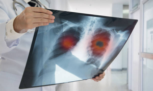 la prevención del cáncer de pulmón