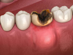 Elimina la caries dental 