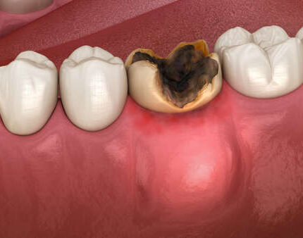 Elimina la caries dental