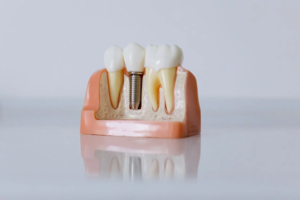 el implante dental
