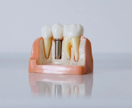 El implante dental