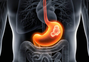Tipos de cáncer del sistema digestivo