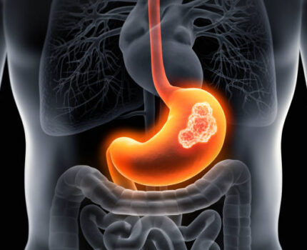 TIPOS DE CÁNCER DEL SISTEMA DIGESTIVO: